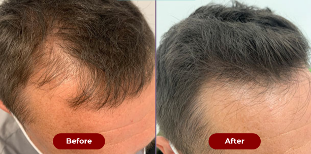 TruGowth 3-in-1 Hair Growth Brush