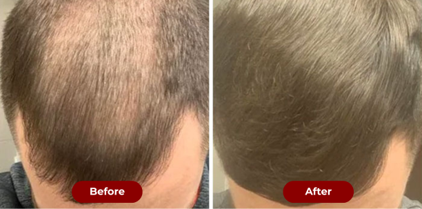 TruGowth 3-in-1 Hair Growth Brush